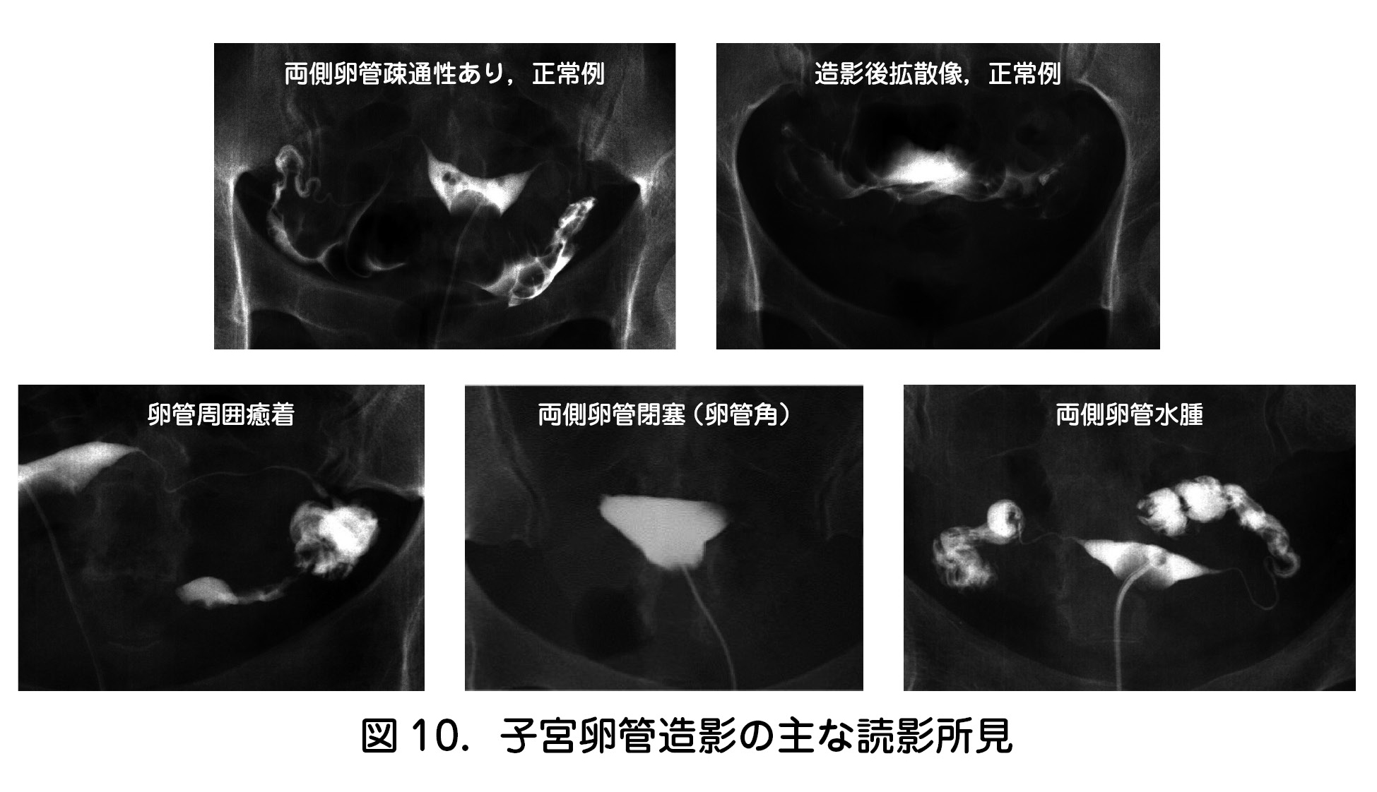 図10．子宮卵管造影の主な読影所見