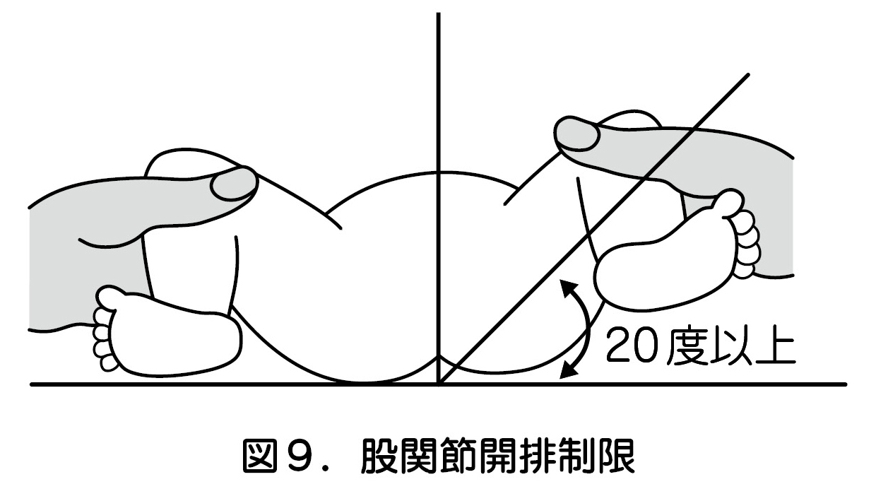 図9.股関節開排制限