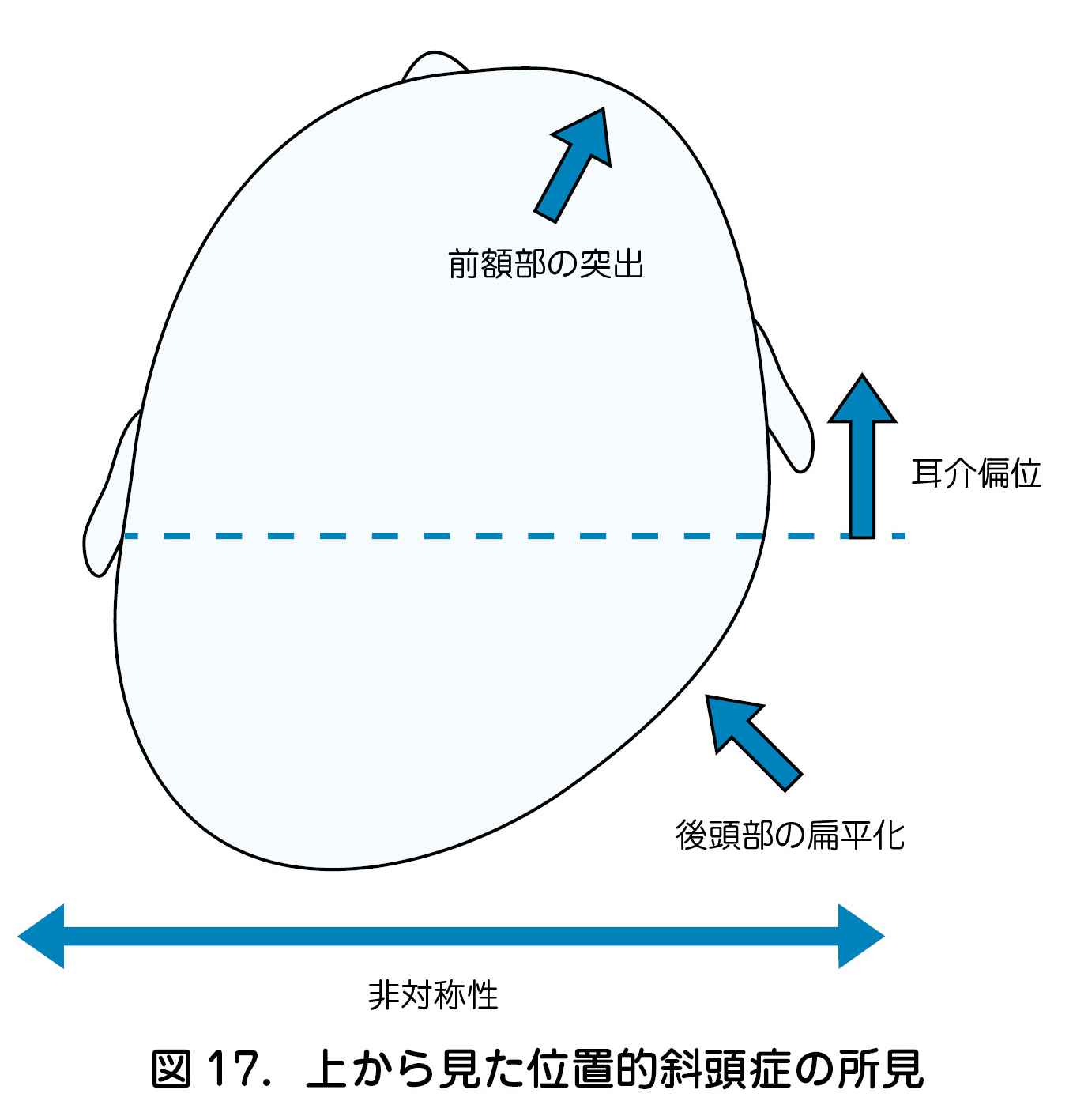 図 17．上から見た位置的斜頭症の所見