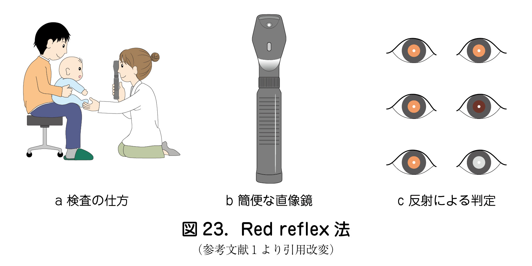 a 検査の仕方 b 簡便な直像鏡 c 反射による判定  図 23．Red reflex 法  （参考文献１より引用改変）