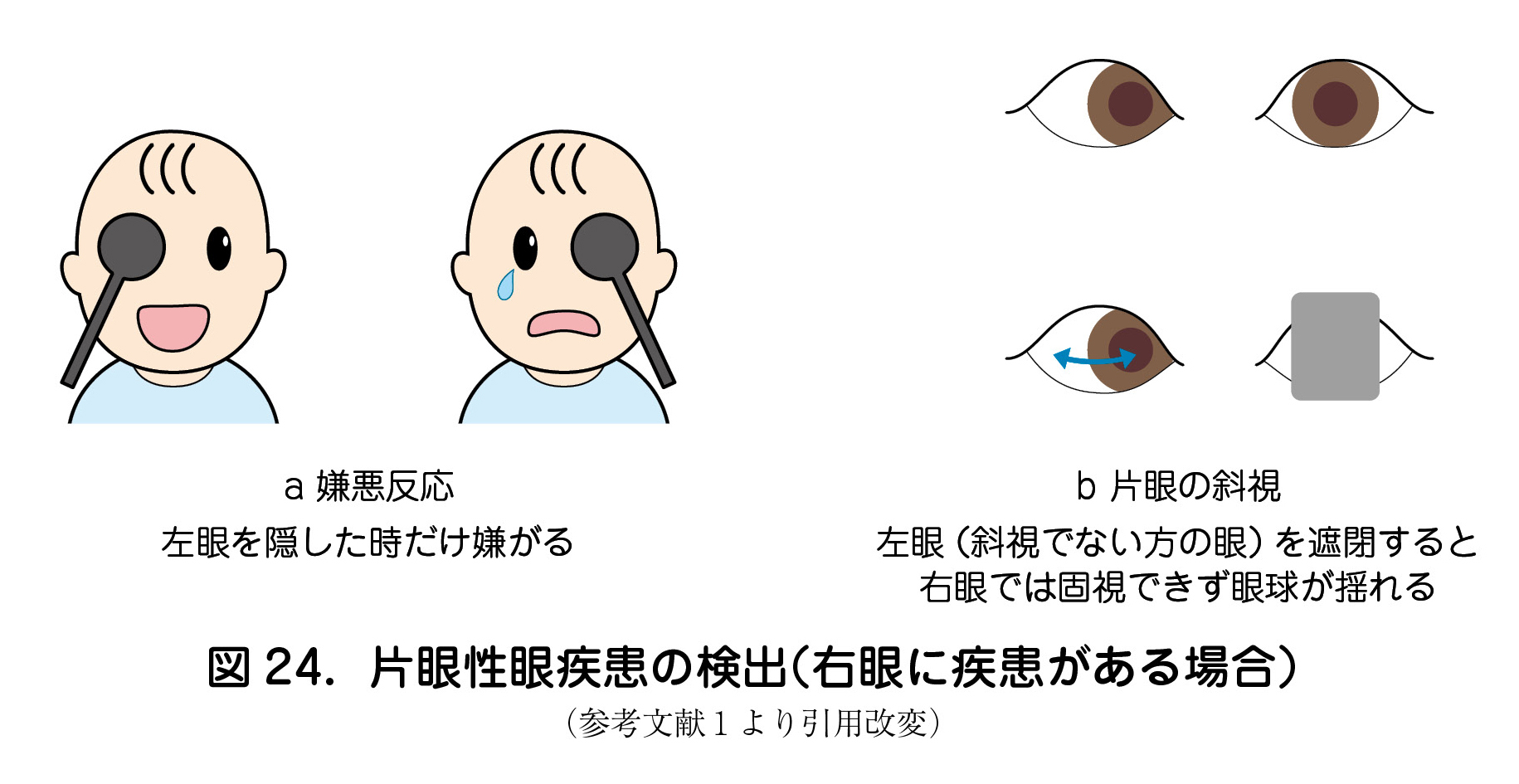 a 嫌悪反応  左眼を隠した時だけ嫌がる  b 片眼の斜視  左眼（斜視でない方の眼）を遮閉すると  右眼では固視できず眼球が揺れる  図 24．片眼性眼疾患の検出（右眼に疾患がある場合）  （参考文献１より引用改変）