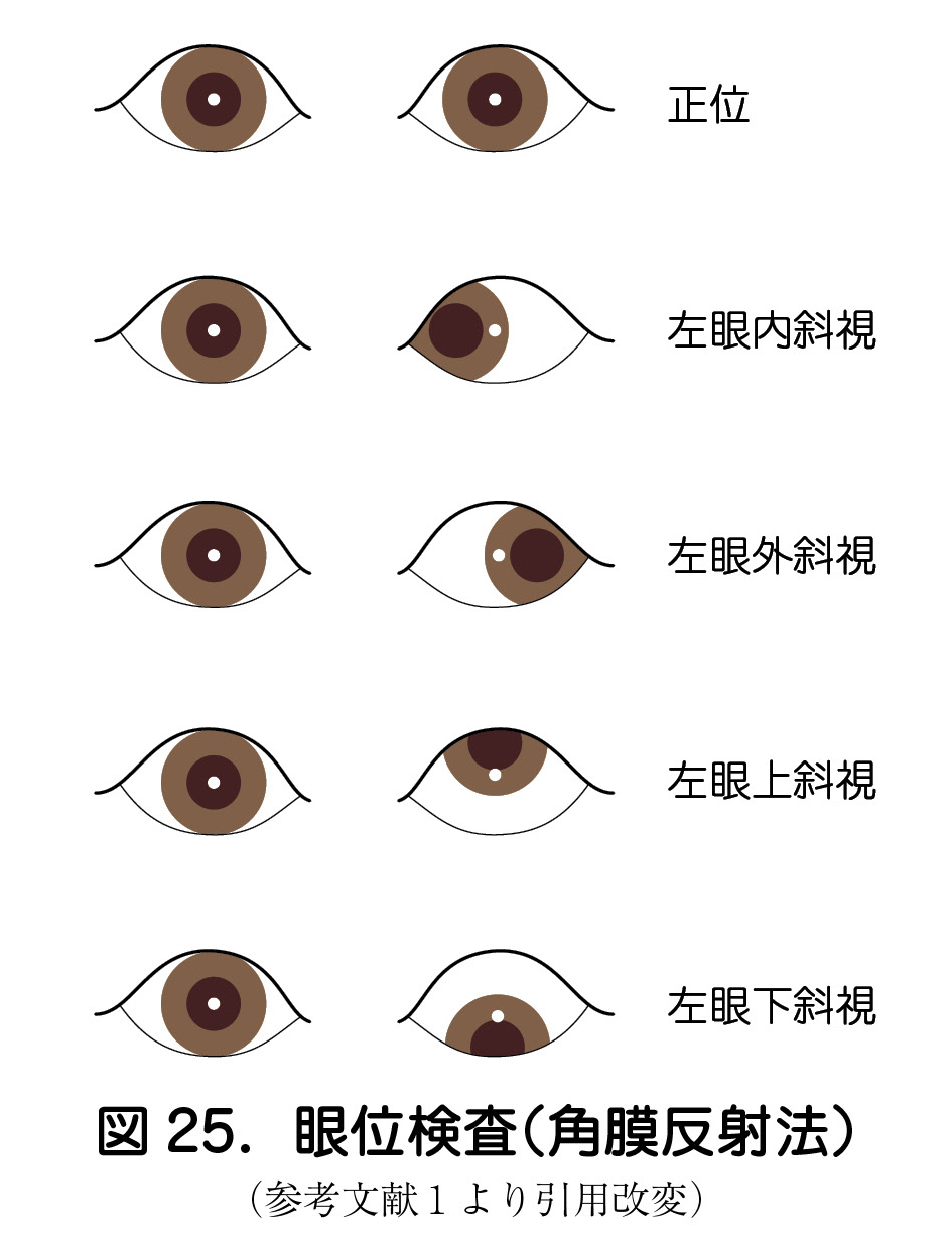 図 25．眼位検査（角膜反射法）（参考文献１より引用改変）