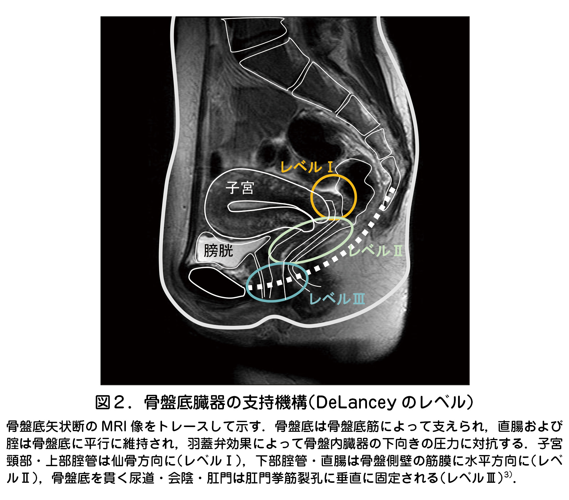 図２．骨盤底臓器の支持機構（DeLancey のレベル）  骨盤底矢状断の MRI 像をトレースして示す．骨盤底は骨盤底筋によって支えられ，直腸および  腟は骨盤底に平行に維持され，羽蓋弁効果によって骨盤内臓器の下向きの圧力に対抗する．子宮  頸部・上部腟管は仙骨方向に（レベルⅠ），下部腟管・直腸は骨盤側壁の筋膜に水平方向に（レベ  ルⅡ），骨盤底を貫く尿道・会陰・肛門は肛門挙筋裂孔に垂直に固定される（レベルⅢ）3）．