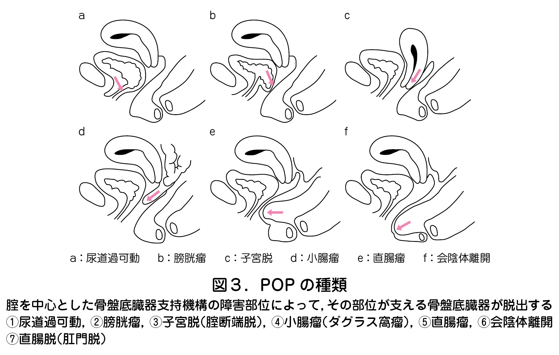 a：尿道過可動 b：膀胱瘤 c：子宮脱 d：小腸瘤 e：直腸瘤 f：会陰体離  図３．POP の種類  腟を中心とした骨盤底臓器支持機構の障害部位によって，その部位が支える骨盤底臓器が脱出する．  ①尿道過可動，②膀胱瘤，③子宮脱（腟断端脱），④小腸瘤（ダグラス窩瘤），⑤直腸瘤，⑥会陰体離開，  ⑦直腸脱（肛門脱）