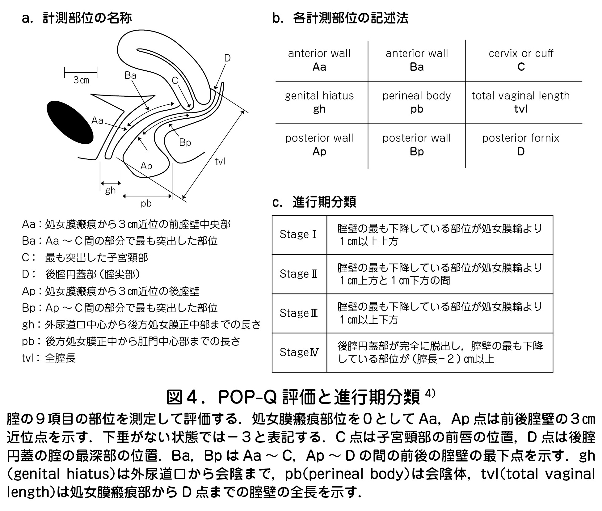 a．計測部位の名称　b．各計測部位の記述法　c．進行期分類　図４．POP-Q 評価と進行期分類 4）  腟の９項目の部位を測定して評価する．処女膜瘢痕部位を０として Aa，Ap 点は前後腟壁の３㎝  近位点を示す．下垂がない状態では－３と表記する．C 点は子宮頸部の前唇の位置，D 点は後腟  円蓋の腟の最深部の位置．Ba，Bp は Aa ～ C，Ap ～ D の間の前後の腟壁の最下点を示す．gh  （genital hiatus）は外尿道口から会陰まで，pb（perineal body）は会陰体，tvl（total vaginal  length）は処女膜瘢痕部から D 点までの腟壁の全長を示す．