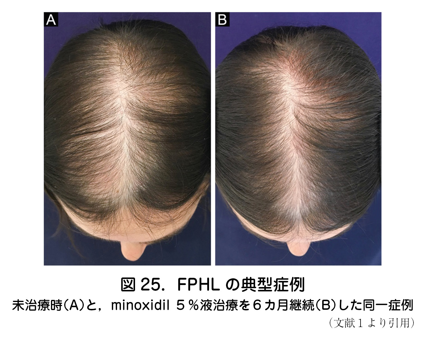 図 25.FPHL の典型症例 未治療時(A)と,minoxidil 5%液治療を6カ月継続(B)した同一症例 (文献1より引用)