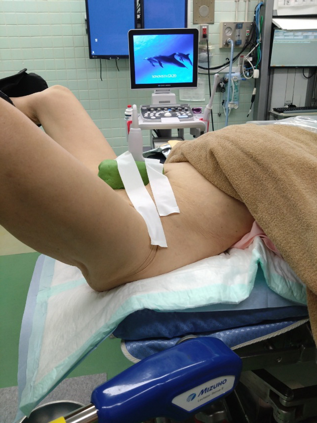 図　経腹プローベの腹壁固定例