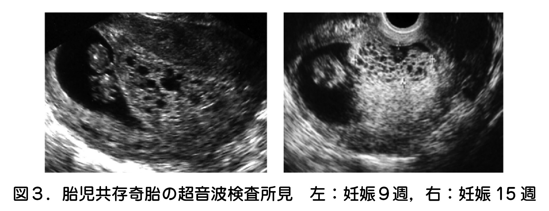 胎児共存奇胎の超音波検査所見 左:妊娠9週,右:妊娠 15 週