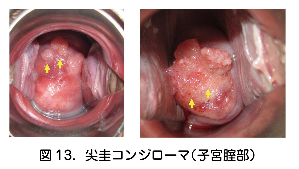 尖圭コンジローマ(子宮腟部)